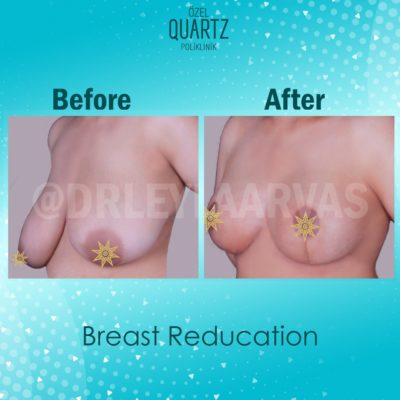 breast reduction