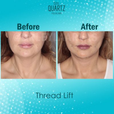 thread lift