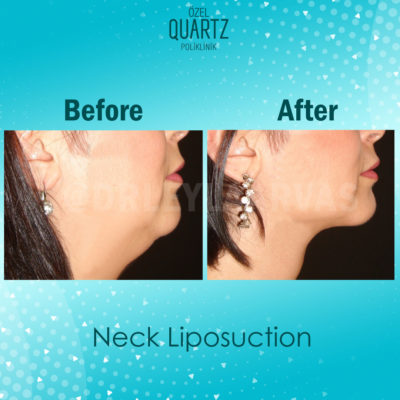 neck liposuction