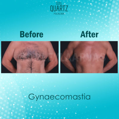 gynaecomastia