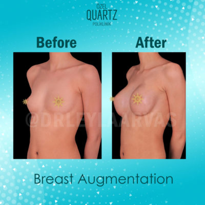 breast augmentation