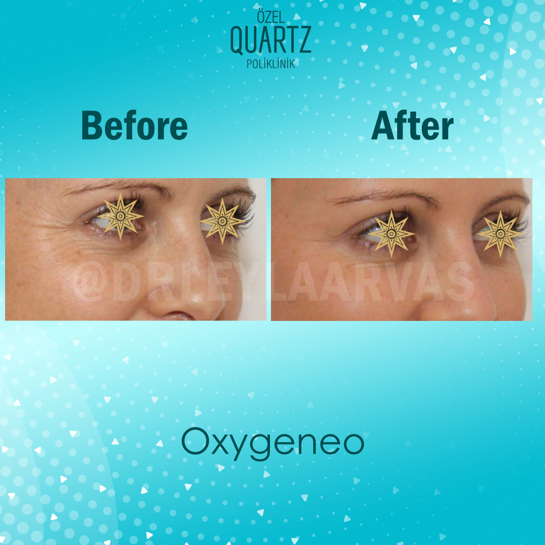 oxygeneo