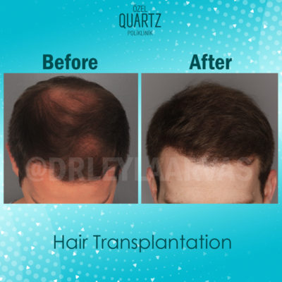 hair transplant