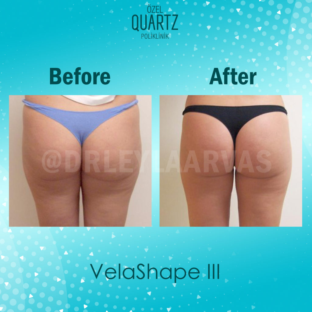 velashape