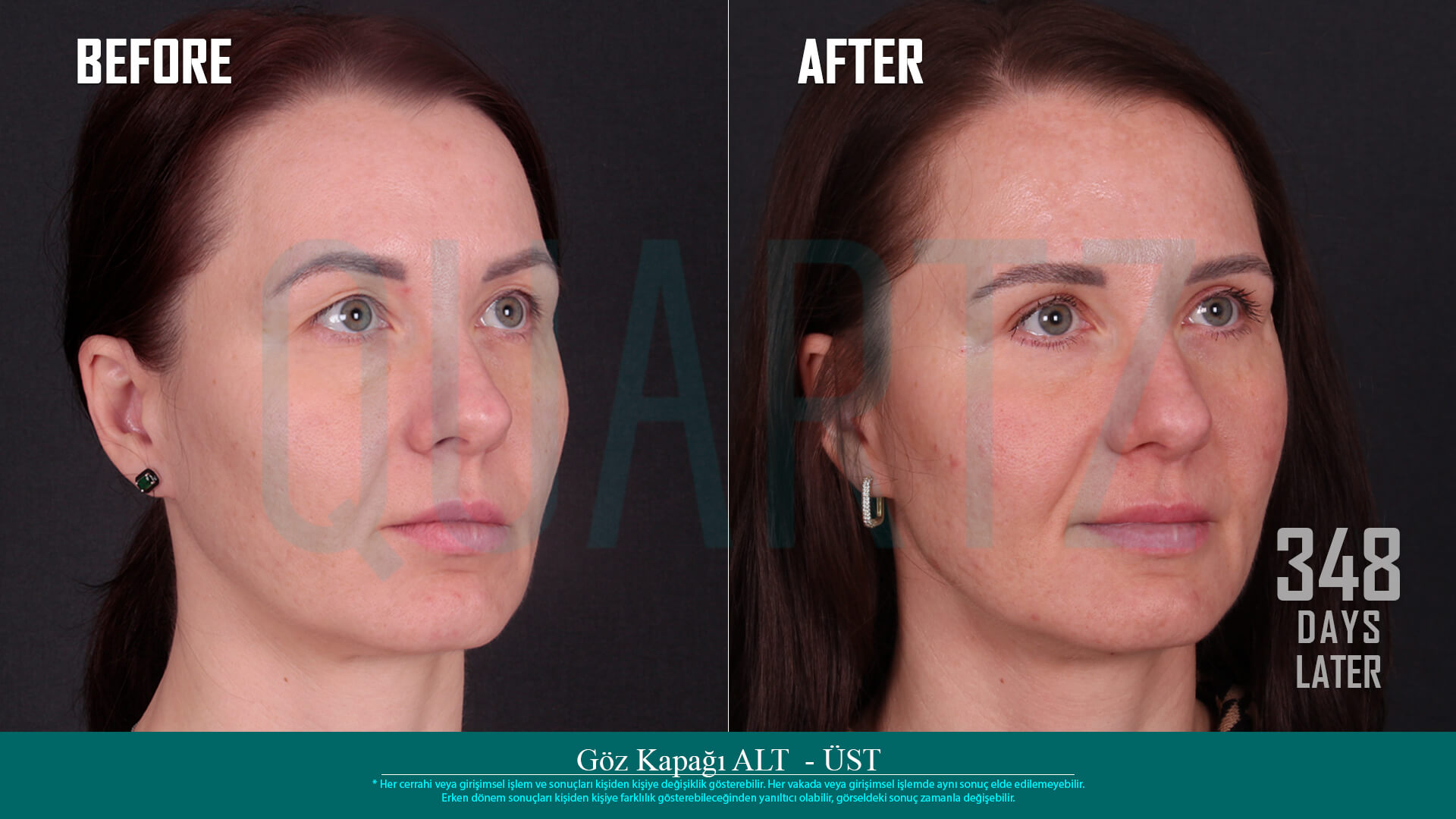 eyelid surgery before after (1)